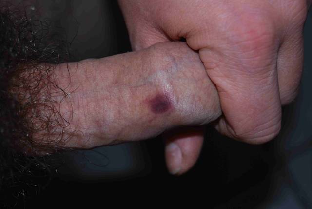 Która mnie tak ugryzła? - adzio67